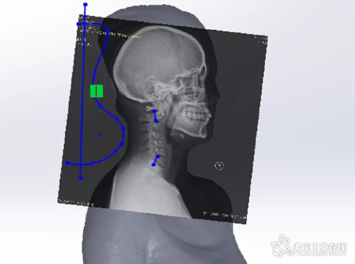 结合X光片测量颈椎曲度