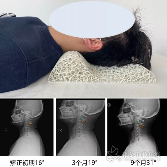 适配个性化颈椎枕